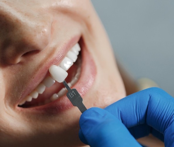 dental veneers, վինիրների տեղադրում