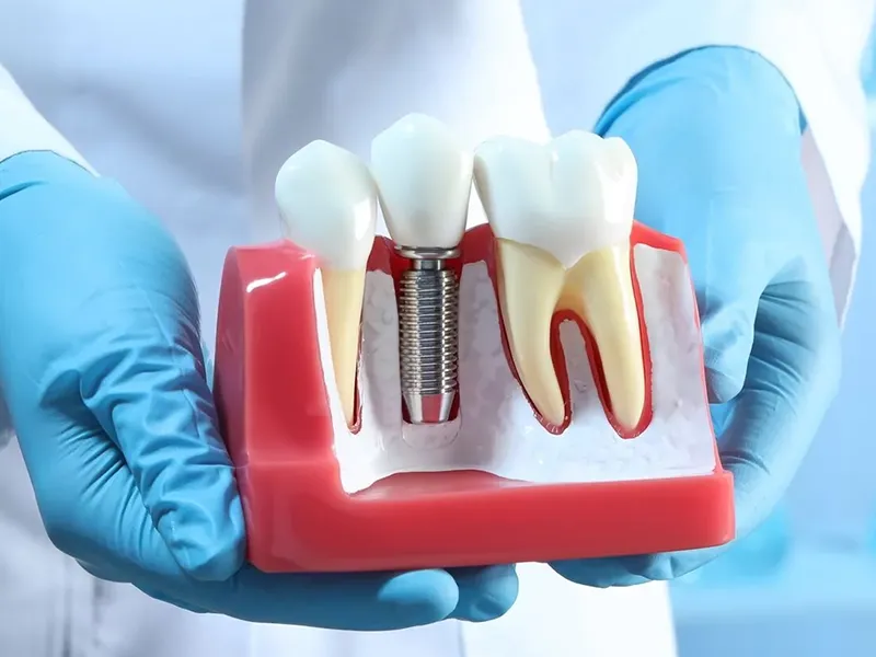 իմպլանտ արժեք